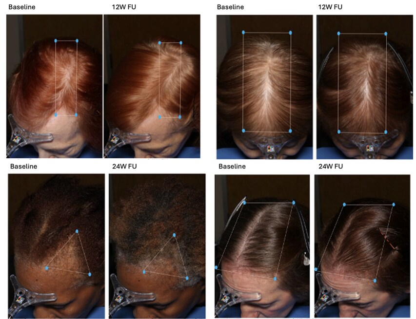 Clinical Study: AI-Powered Hair Loss Solution by MDhair