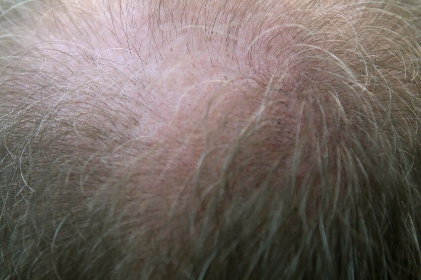 hair thinning male