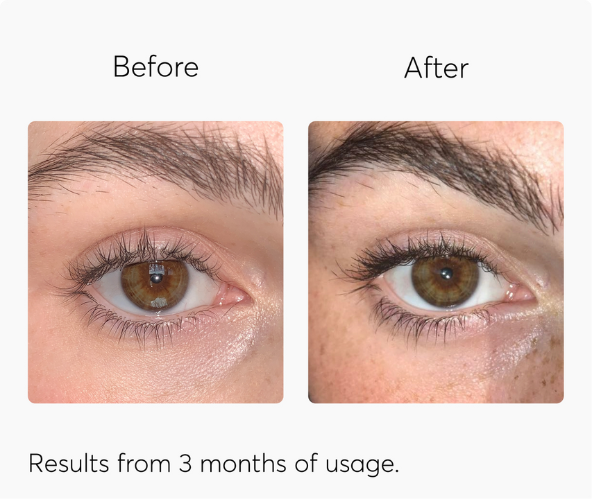 Mdhair advanced eyelash serum before and after 3 months