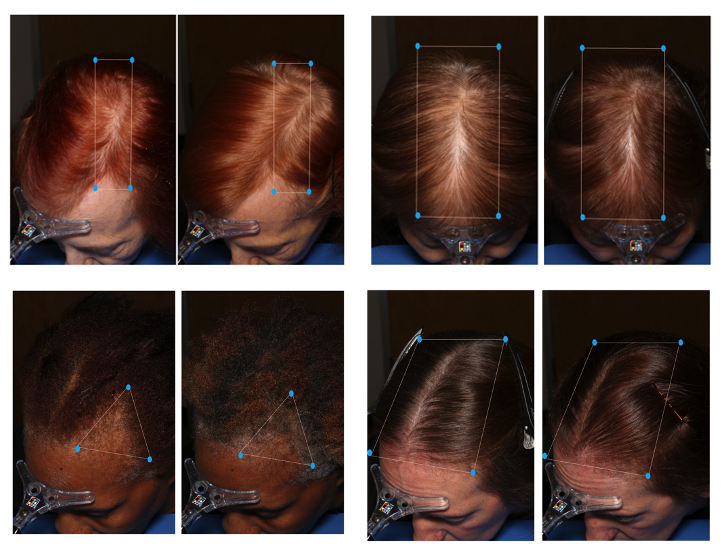 MDhair Clinical Study - Customized treatment including MDhair's marine collagen, Vitamin C, Hyaluronic acid, oral supplements, and topical DHT-blocking serum and shampoo.